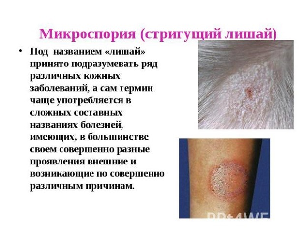Симптомы микроспории у человека, лечение и профилактика