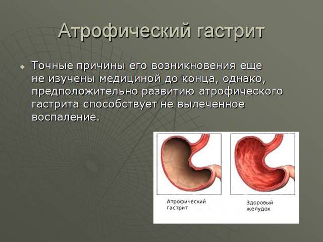 Атрофический гастрит: симптомы и схема лечения