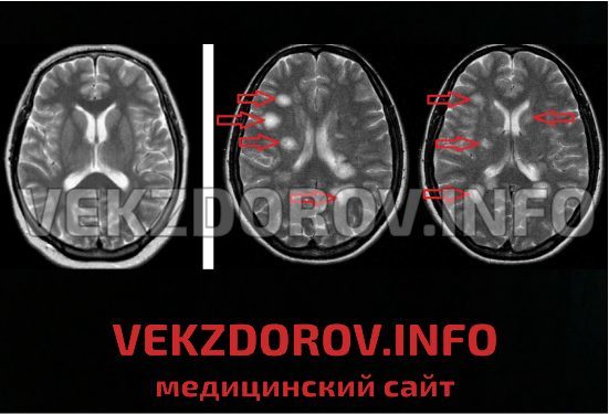 Рассеянный склероз, что это такое? Симптомы, лечение и продолжительность жизни