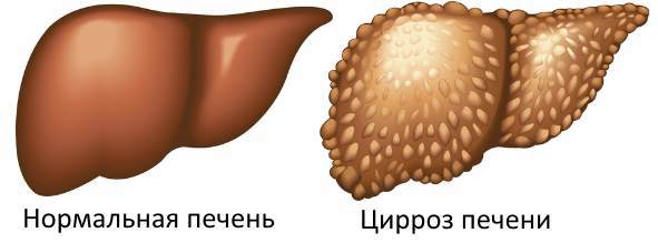 Билиарный цирроз печени: что это такое? Симптомы и лечение
