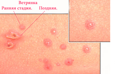 Ветрянка у детей: инкубационный период, первые признаки и симптомы (фото)