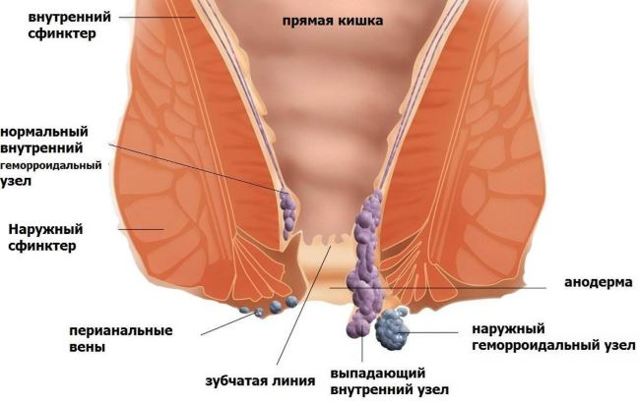 Наружный геморрой: симптомы, фото и способы лечения