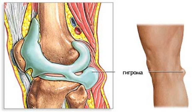 Гигрома: что это такое? Фото, симптомы и лечение
