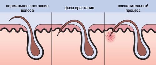 Вросший волос в области бикини, на ногах: как избавиться в домашних условиях
