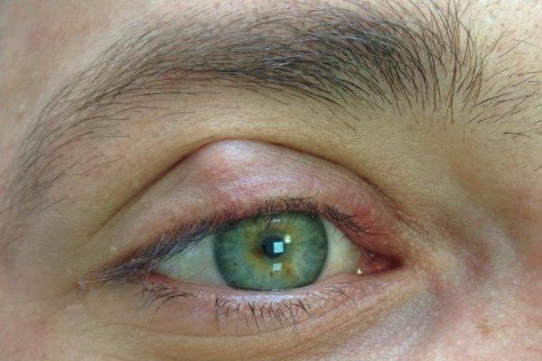 Что такое халязион: симптомы и лечение