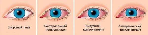 Чем лечить конъюнктивит у детей в домашних условиях