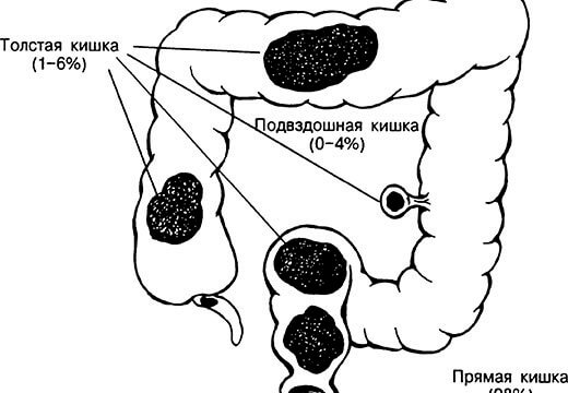 Как избавиться от каловых камней в домашних условиях