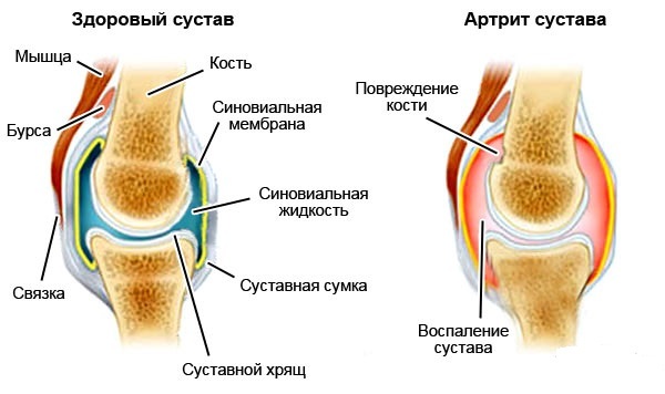 Первые симптомы артрита коленного сустава, лечение и правила профилактики