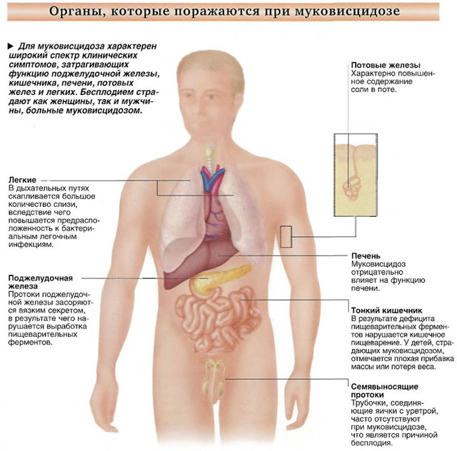 Симптомы муковисцидоза, причины и лечение