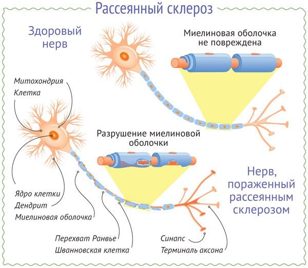 Рассеянный склероз, что это такое? Симптомы, лечение и продолжительность жизни