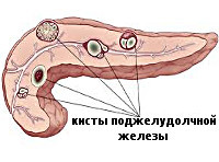Киста поджелудочной железы: симптомы, причины и лечение