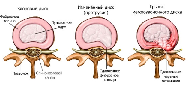 Люмбоишиалгия, что это такое? Симптомы и схема лечения