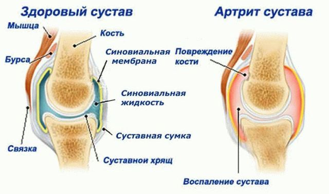 Первые симптомы артрита коленного сустава, лечение и правила профилактики
