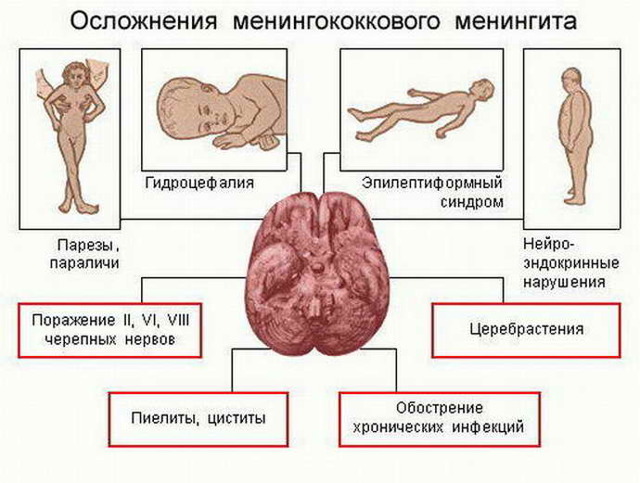 Вирусный менингит: инкубационный период, первые признаки и варианты лечения