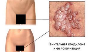 Вирус папилломы человека у женщин, что это такое? Причины и лечение