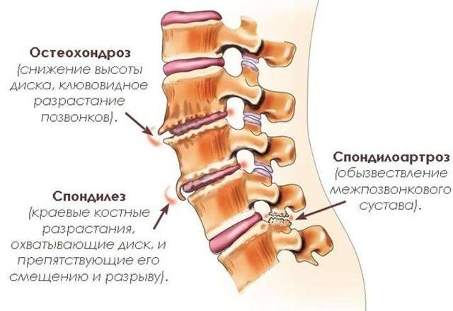 Спондилоартроз пояснично-крестцового отдела позвоночника, что это такое и как лечить?