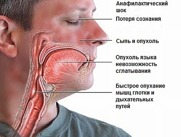 Как проявляется аллергия на алкоголь: красные пятна и другие симптомы