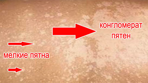 Отрубевидный лишай у человека: симптомы и эффективное лечение