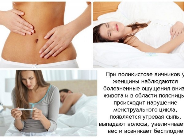 Поликистоз яичников, что это такое? Симптомы и лечение