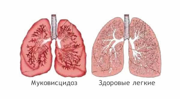 Симптомы муковисцидоза, причины и лечение