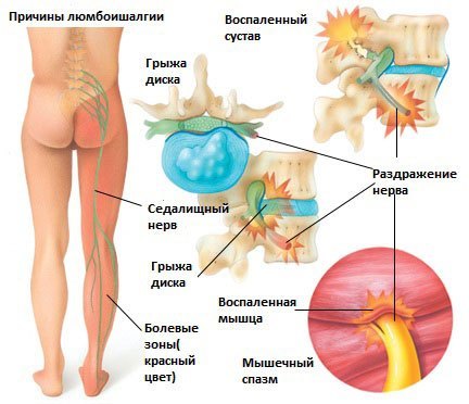 Люмбоишиалгия, что это такое? Симптомы и схема лечения