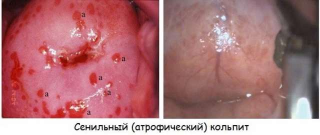 Атрофический кольпит: симптомы и схема лечения у женщин