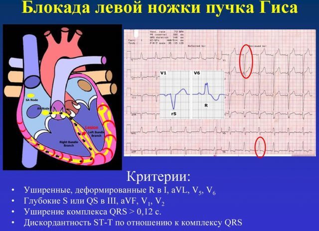 Блокада ножек пучка гиса: что это такое, чем опасно такое состояние?