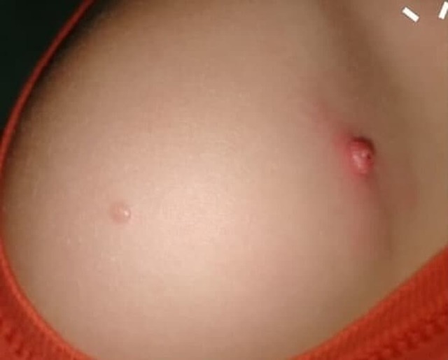 Что такое контагиозный моллюск и как его лечить?