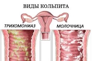Кольпит у женщин, симптомы и лечение