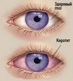 Симптомы кератита, профилактика и схема лечения