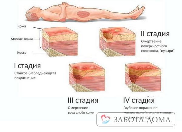Пролежни у лежачих больных: лечение и профилактика, фото в начальной стадии