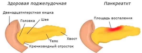 Симптомы панкреатита и схема лечения в домашних условиях