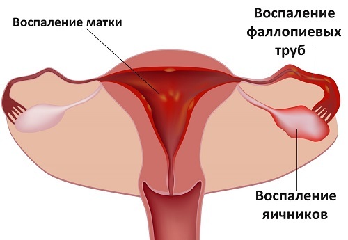Апоплексия яичника: первые симптомы, причины и варианты лечения