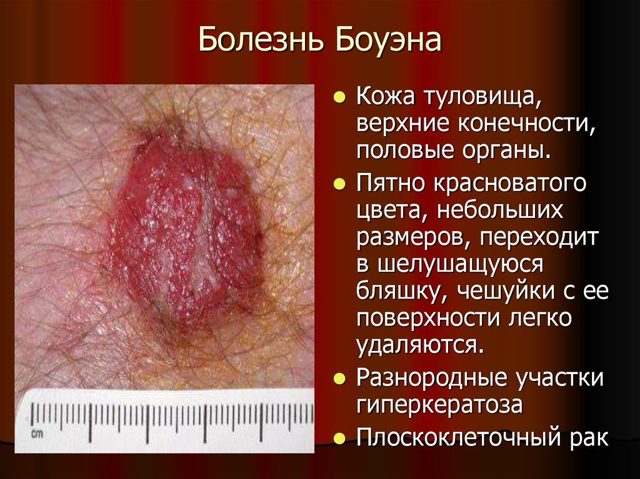Болезнь Боуэна: что это такое? Симптомы и схема лечения