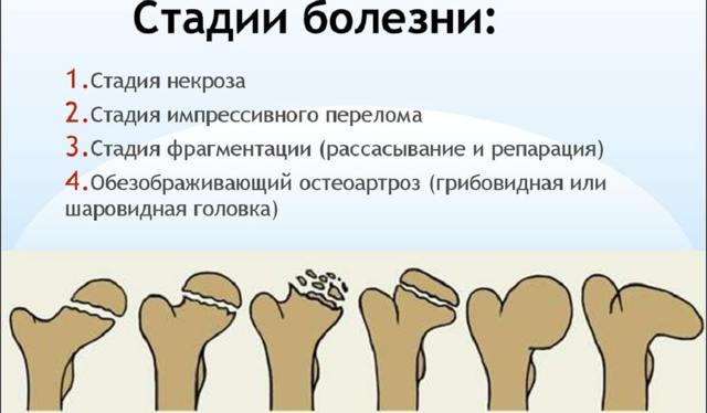 Причины, симптомы и лечение болезни Пертеса у детей и взрослых