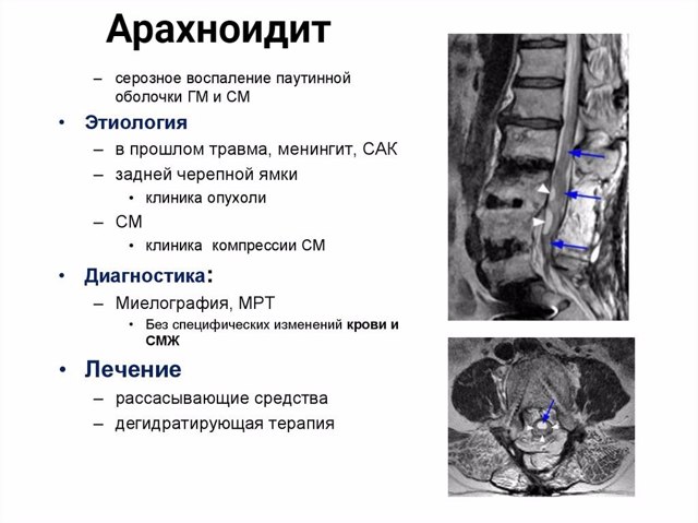Арахноидит головного мозга: симптомы и последствия
