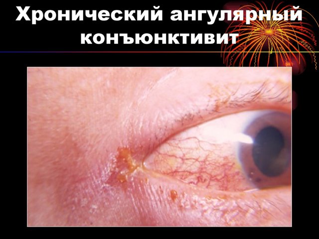 Симптомы конъюнктивита у взрослых, лечение и меры профилактики