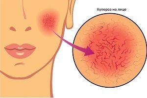 Как удалить сосудистые звездочки? Обзор актуальных процедур