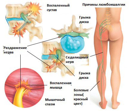 Люмбоишиалгия, что это такое? Симптомы и схема лечения