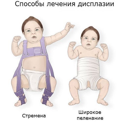Дисплазия тазобедренных суставов у новорожденных детей (грудничков)