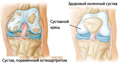 Первые симптомы артрита коленного сустава, лечение и правила профилактики