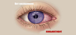Симптомы конъюнктивита у взрослых, лечение и меры профилактики