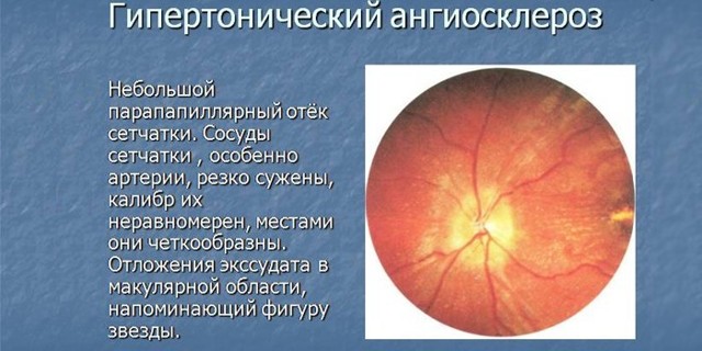 Лечение гипертонии 2 степени, симптомы и причины возникновения