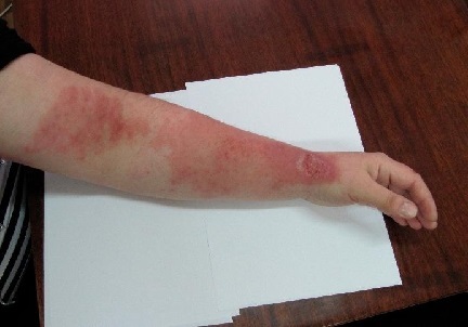 Болезнь кошачьих царапин: проявления болезни и способы лечения