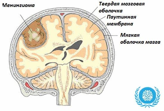 Симптомы и лечение менингиомы головного мозга — прогноз и последствия после удаления опухоли