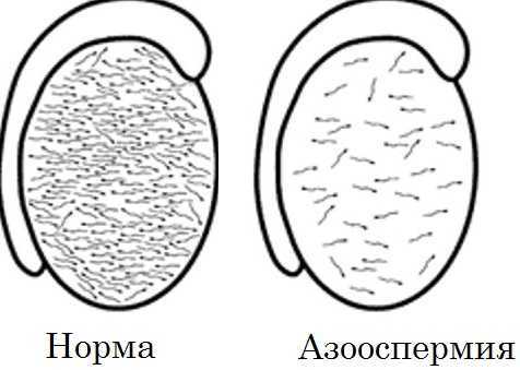 Азооспермия что это такое: причины, лечение, отзывы мужчин