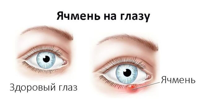 Быстрое лечение ячменя на глазу за 1 день в домашних условиях