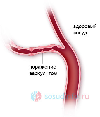 Болезнь Бехчета: что это такое? Симптомы и варианты лечения