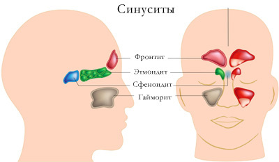 Синусит у взрослых: симптомы и схема лечения на дому