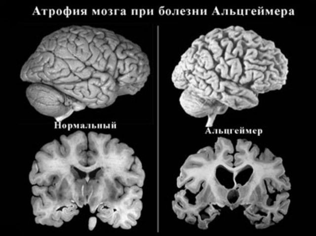 Болезнь Альцгеймера: что это такое? Симптомы, лечение и профилактика